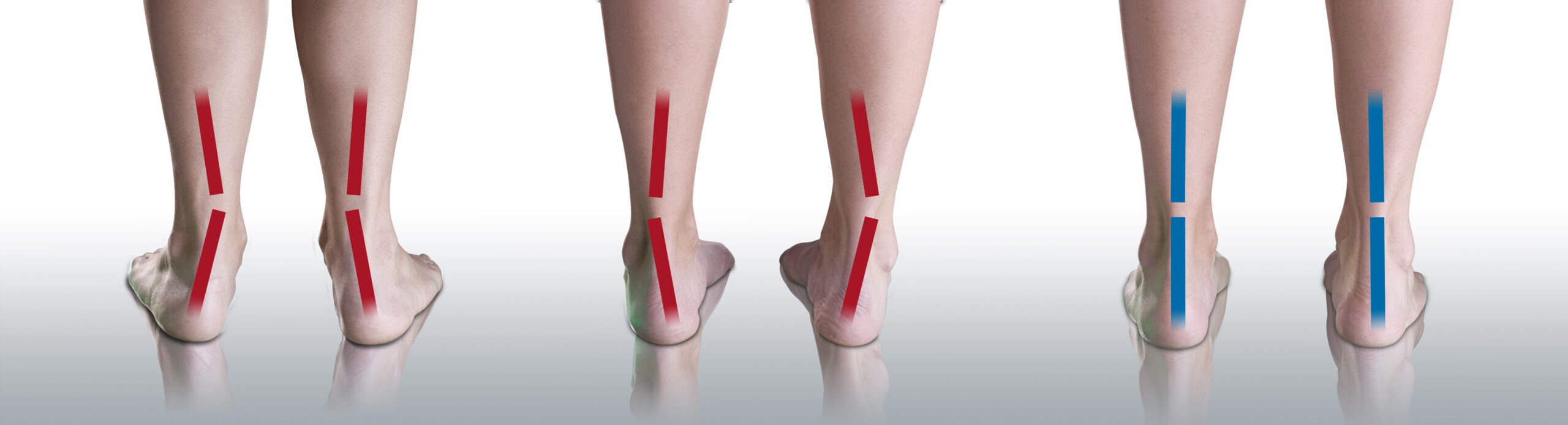 PRONACJA/NEUTRAL/SUPINACJA